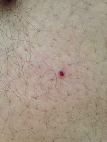 Could this be melanoma I m really worried