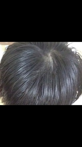 Is this just a big cowlick or crown, or am I thinning