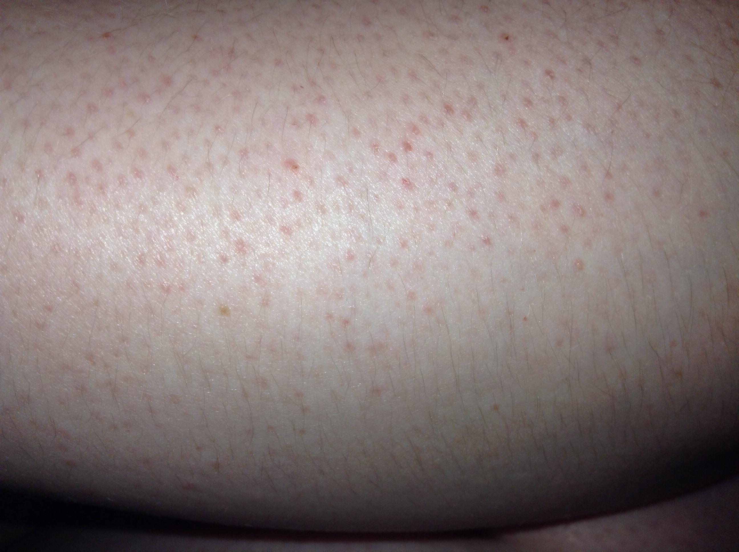 What are these little red bumps on my skin - 1