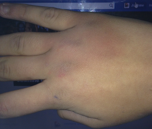 Punched a wall and messed up my hand - 1
