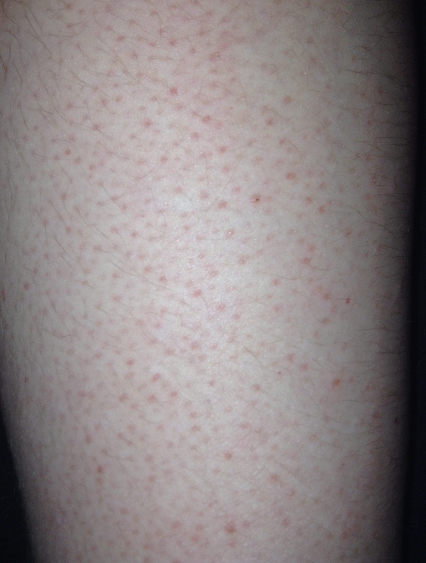 What are these little red bumps on my skin